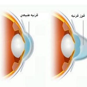 پاورپوینت بیماری قوز قرنیه یا کراتوکونوس