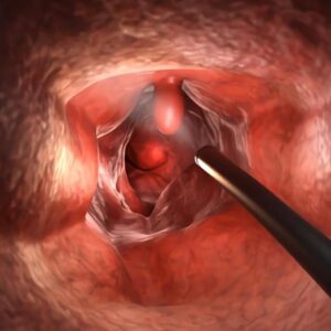 پاورپوینت پولیپ معده Stomach polyps چیست