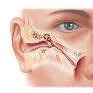پاورپوینت بررسی اختلال شیپور استاش گوش
