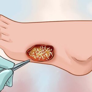 پاورپوینت آشنایی لارو درمانی Larvae therapy