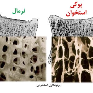 دانلود پاورپوینت بررسی پوکی استخوان